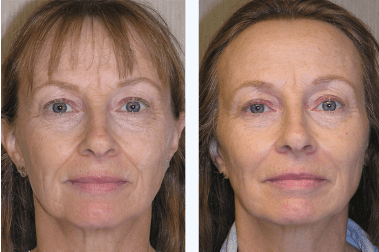 before and after results