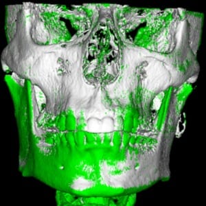30-year-old male patient with the Homeoblock™ for 24 months.