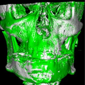 58-year-old male patient with the Homeoblock™ for 24 months.
