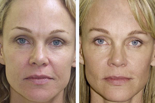 Before and After Treatment with the Homeoblock™