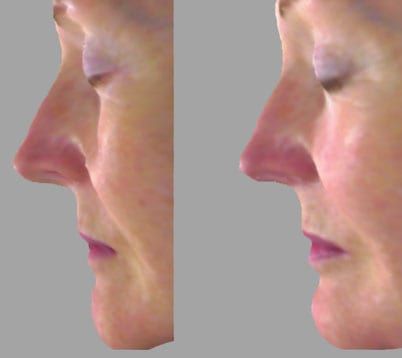 Palate Expander Can Change your Face! Here's how