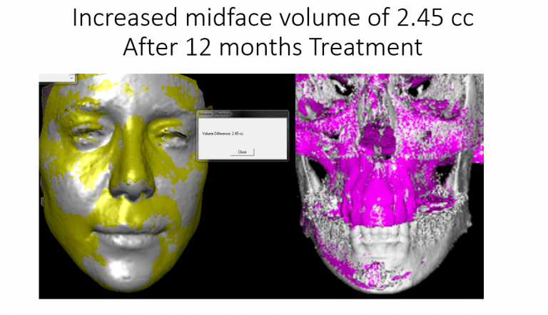 Increasing mid-face volume arrests and reverses premature aging of the face.