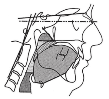 Breathing Dysfunction and Head Posture - Dr. Theodore Belfor, DDS